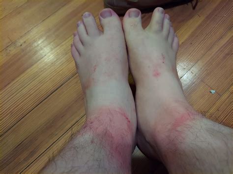 Very Itchy Rash Around Ankles Persistent For Weeks R