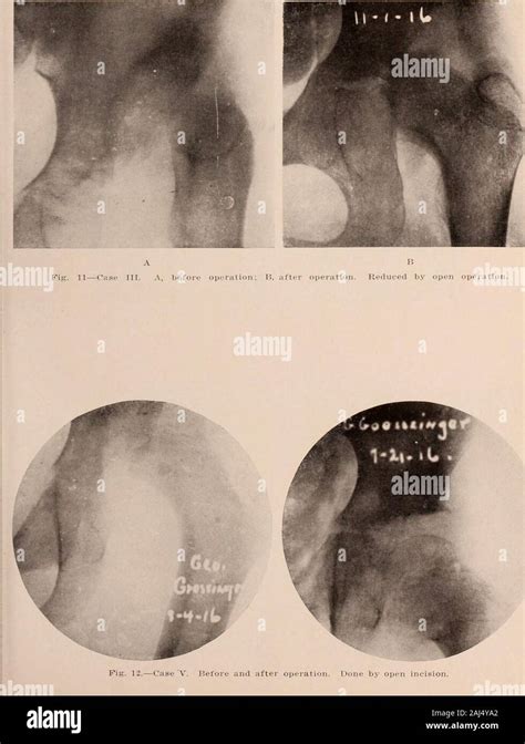 Congenital Dislocation Of The Hip Hi Res Stock Photography And Images