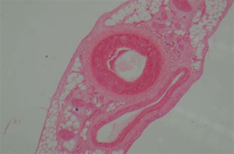 囊性增生乳腺病 39健康网 外科疾病