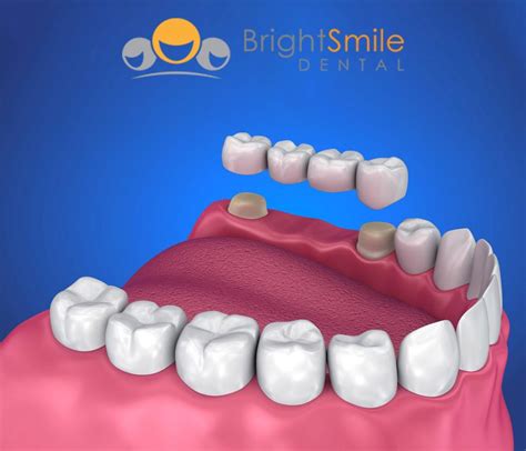 Dental Bridge Vs Implant What S Best Bright Smile Dental Powell