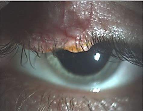 Sebaceous Cyst Eyelid