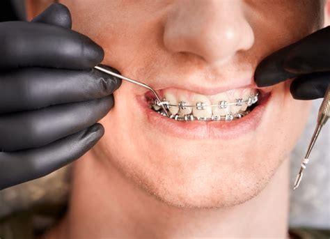 Cuánto dura un tratamiento de ortodoncia Gaceta Dental