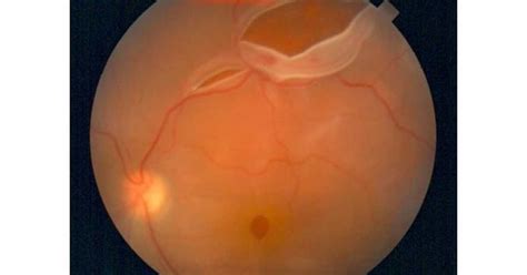 Rhegmatogenous Retinal Detachment Ask The Eye Doctor Webeyeclinic