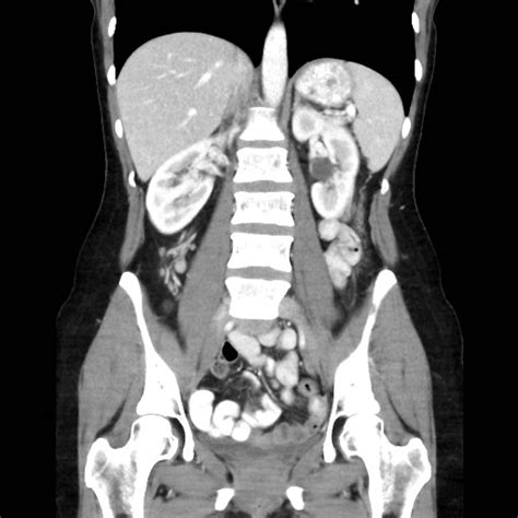 Colocolonic Intussusception Image Radiopaedia Org