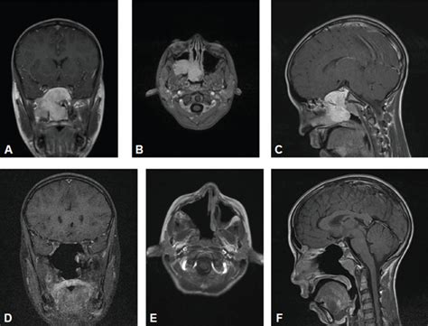 Juvenile Nasopharyngeal Angiofibroma Radiology