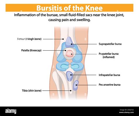 Inflammation of knee bursae causing pain and swelling Stock Vector Image & Art - Alamy