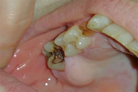 Tooth Abscess Treatment Symptoms Antibiotics And Stages