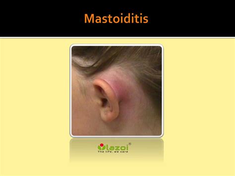 Ppt Mastoiditis Causes Symptoms Daignosis Prevention And