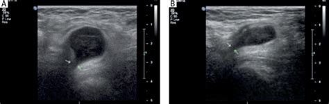 Femoral Vs Inguinal Hernia Ultrasound