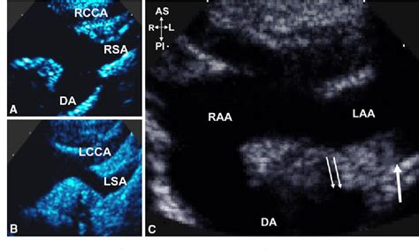 A Rare Type Of Double Aortic Arch Diagnosed By Echocardiography In An Asymptomatic 9 Year Old