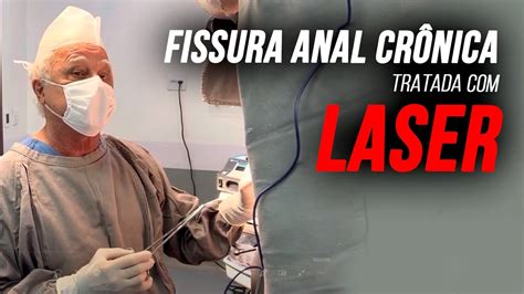 Fissuras Anal Crônicas Tratada Laser Sob Anestesia Local Sem Internação