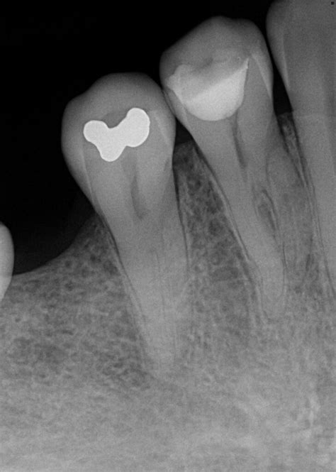 Minimally Invasive Endodontics With Laser Activated Irrigation