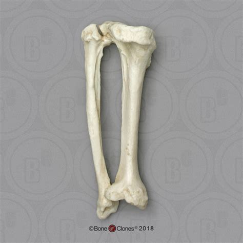 Human Female Achondroplasia Dwarf Left Tibia and Fibula, Fused - Bone ...