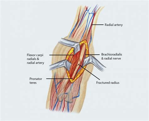 Forearm Fracture Fixation - Avanti