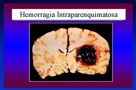 Enfermedades Vasculares Cerebrales Tema 3 Hemorragia Cerebral Definicin