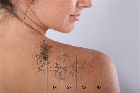 Laser Tattoo Removal Eluma Laser And Aesthetics