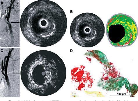 Figure 3 From Virtual Histology Intravascular Ultrasound In Carotid