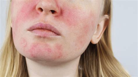 How Is Rosacea Treated 4 Things That Actually Helped Rosacea Rxmoore