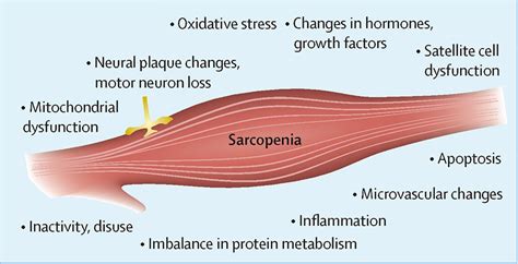 Sarcopenia - InBodyCanada