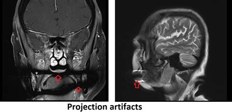 Mri Projection Artifact Braces Mri Artifact Titanium Mri Artifact