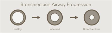 Outsmart Bronchiectasis With These Treatments Smartvest