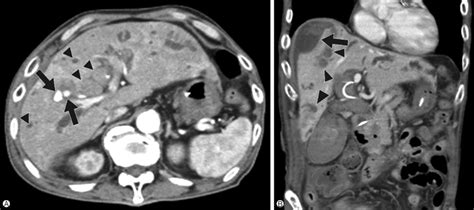 Follow Up Abdominal Computed Tomography A Two Intrahepatic