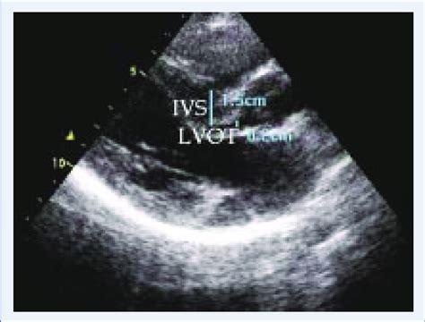 Left Ventricular Outflow Tract Lvot Became Severely Stenotic During