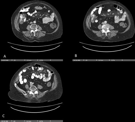 Mesenteric Panniculitis In A Patient With New Onset Dermatomyositis Bmj Case Reports