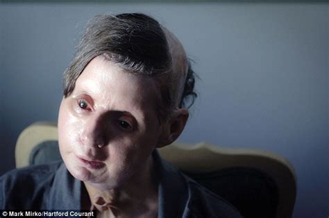 Charla Nash Astonishing Progress Of Chimp Attack Victim 2 Years After