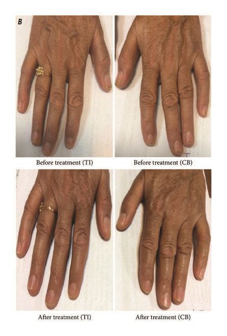 A A Patient With Nail Matrix Involvement Pitting B Patient With Download Scientific