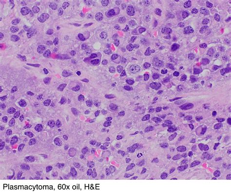 Pathology Outlines - Plasmacytoma