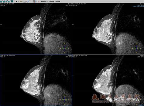 【医学影像科】成功开展乳腺磁共振功能成像及动态增强新技术