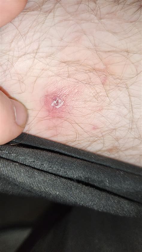 Brown recluse? : r/spiderbites