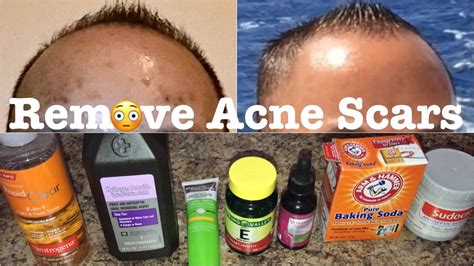 How To Remove Acne Scars Dark Age Spots Or Uneven Skin Tone Review