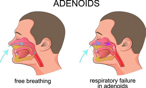 Adenoidectomy