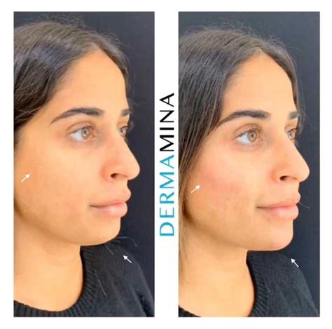 Dermal Filler Packages London Dermamina