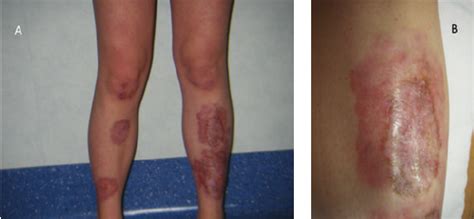 Skin Lesions Typically Appear On The Legs A Particular Of The Skin Download Scientific