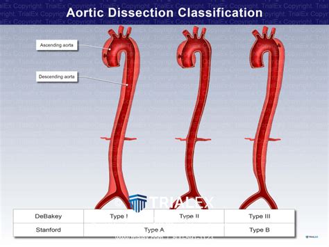 Aortic Dissection Classification Trial Exhibits Inc