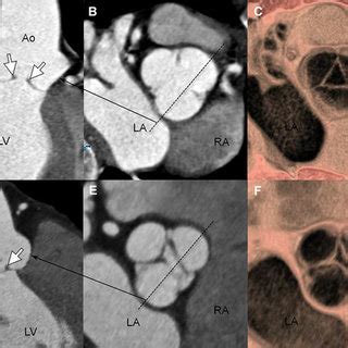 Type 1 Aortic Regurgitation Cases A A 56 Year Old Male Patient With A