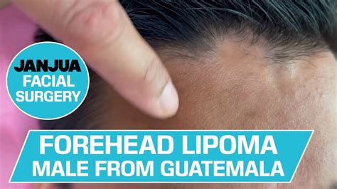 Forehead Lipoma In A Male From Guatemala Dr Tanveer Janjua New