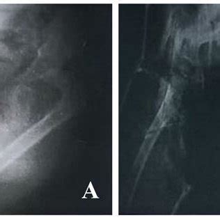 A Eshowing An Illustrative Case With A Preop X Ray B Immediate Post Op