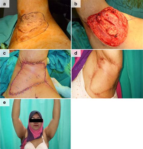 Intraoperative Image Of Severe Left Axillary Hidradenitis Suppurativa