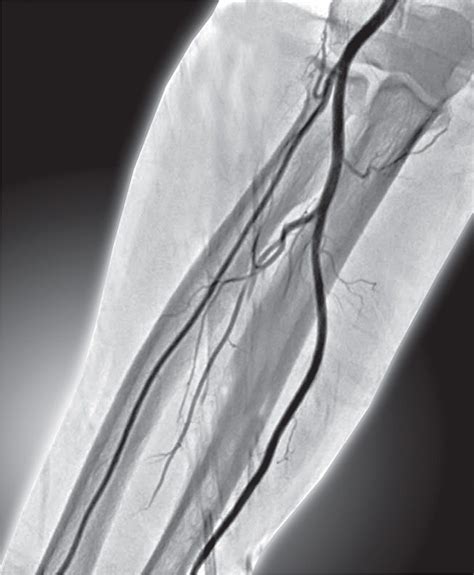 Radial Artery versus Ulnar Artery Catheterization | Thoracic Key