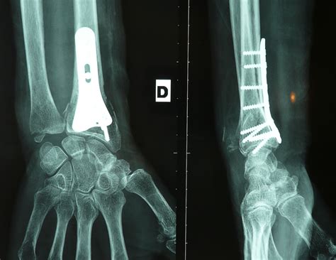 Fracture Du Poignet Institut Europ En De La Main