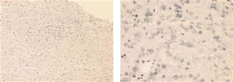 Iron location in the patient's liver. Left: low power photomicrograph ...