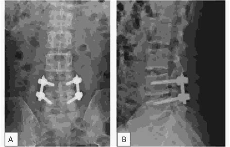 Two Year Outcomes Of Midline Lumbar Fusion Versus Minimally Invasive Transforaminal Lumbar