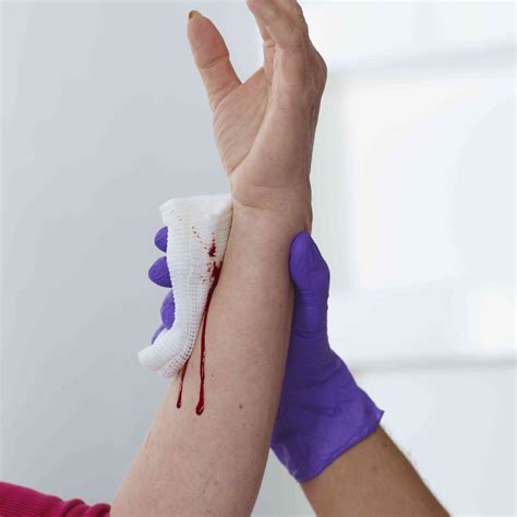 Wound Care In The Emergency Department at Warren Short blog