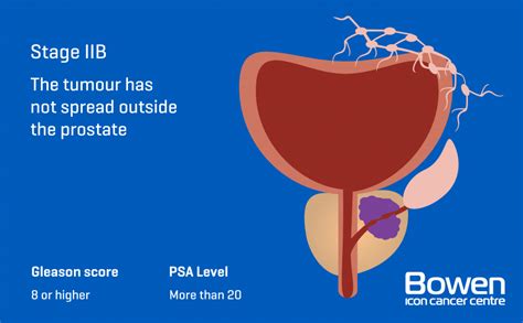 What Is Prostate Cancer Prostate Cancer Explained — Bowen Icon Cancer Centre