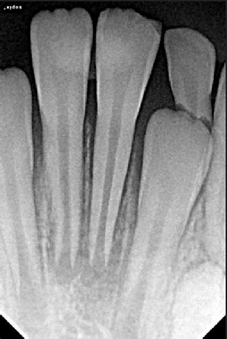 Avulsed tooth (tooth #31) two weeks after replantation. | Download ...