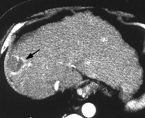 Tumor Recurrence After Radiofrequency Thermal Ablation Of Hepatic